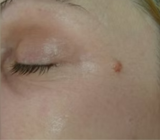 rakus-pelleve-beforeafter-eyes4