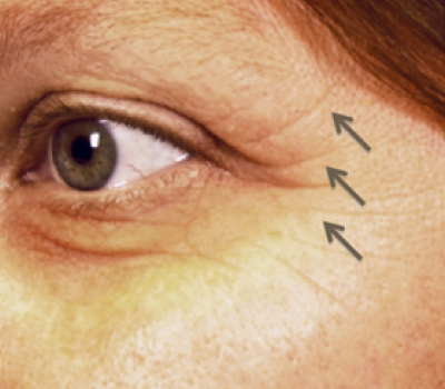 rakus-pelleve-beforeafter