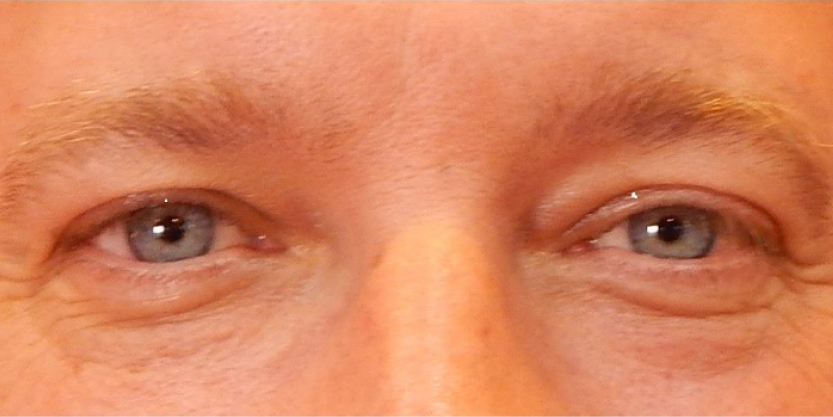 rakus-perk-beforeafter