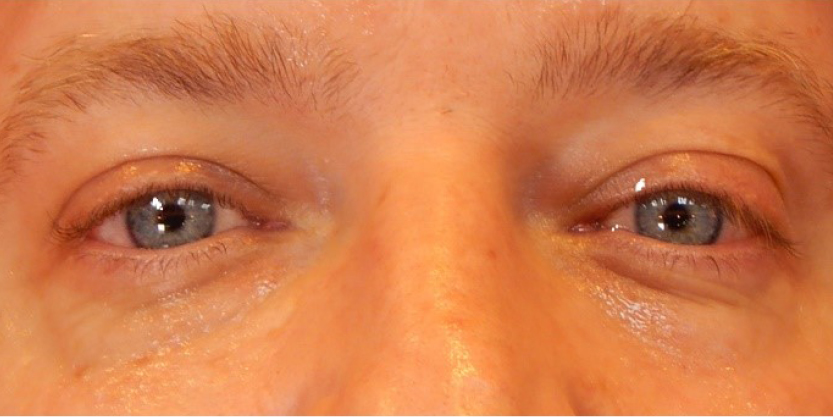 rakus-perk-beforeafter2