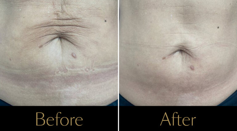 rakus-profhilo-gallery