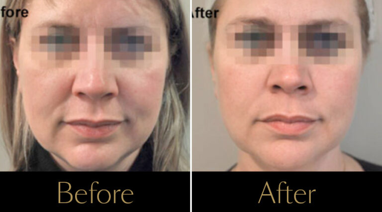 rakus-profhilo-gallery10