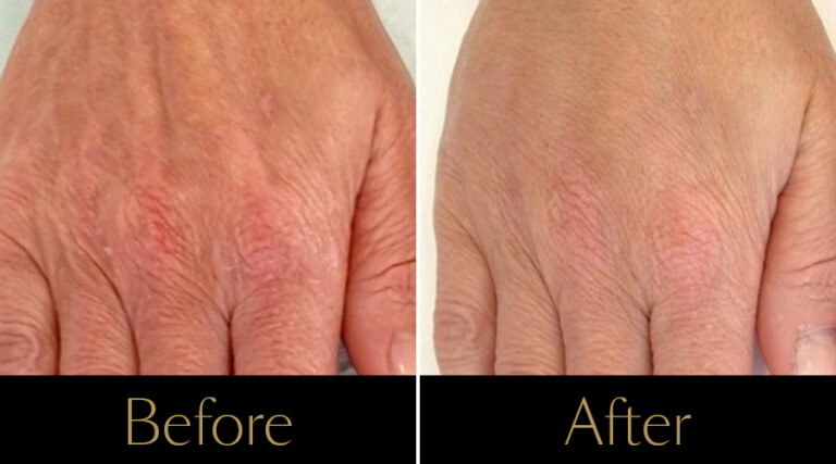 rakus-profhilo-gallery11