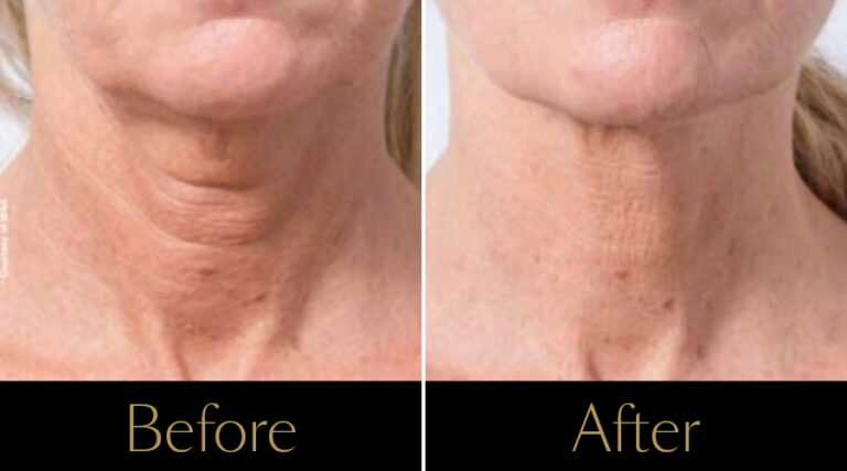 rakus-profhilo-gallery12