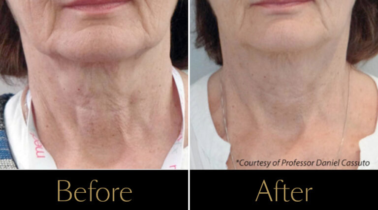 rakus-profhilo-gallery2