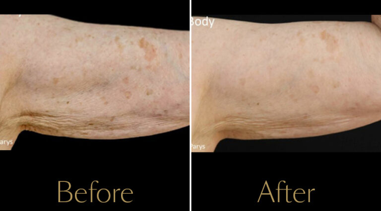 rakus-profhilo-gallery3