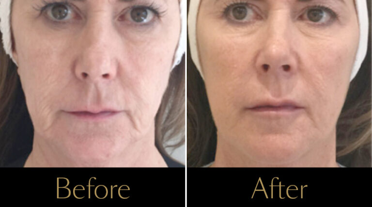 rakus-profhilo-gallery4