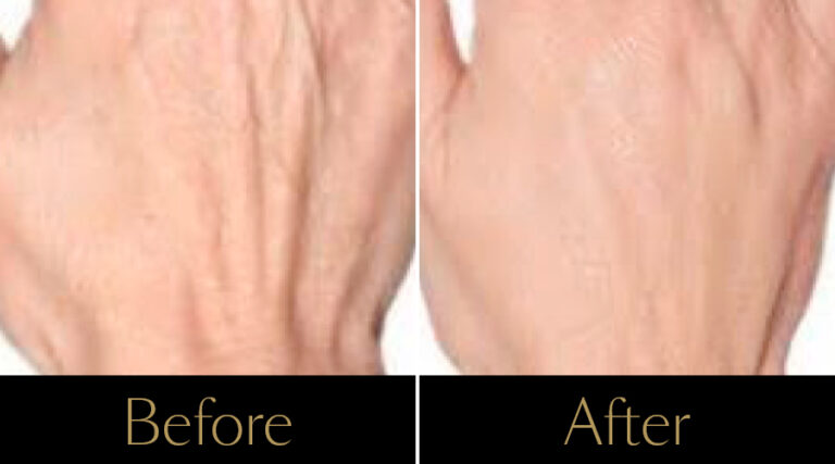 rakus-profhilo-gallery5