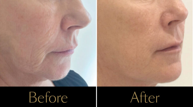 rakus-profhilo-gallery6