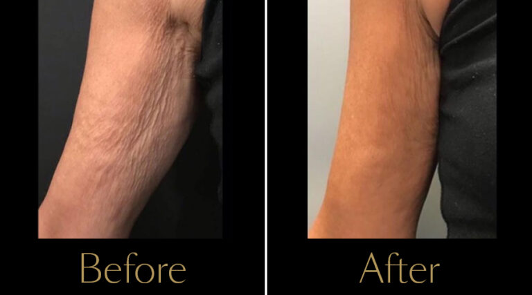 rakus-profhilo-gallery7