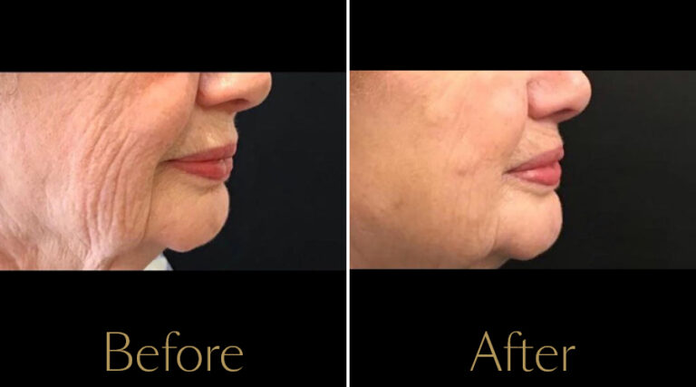 rakus-profhilo-gallery8