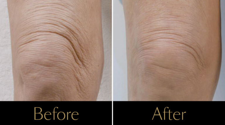 rakus-profhilo-gallery9