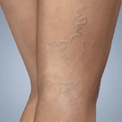 rakus-sclerotherapy-ba