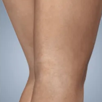 rakus-sclerotherapy-ba2