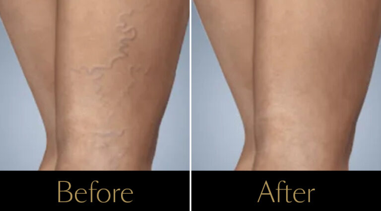 rakus-sclerotherapy-gallery