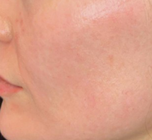 rakus-secret-beforeafter2