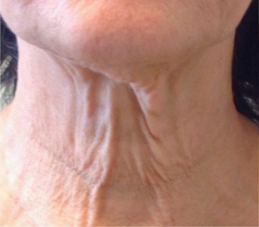 rakus-secret-beforeafter3