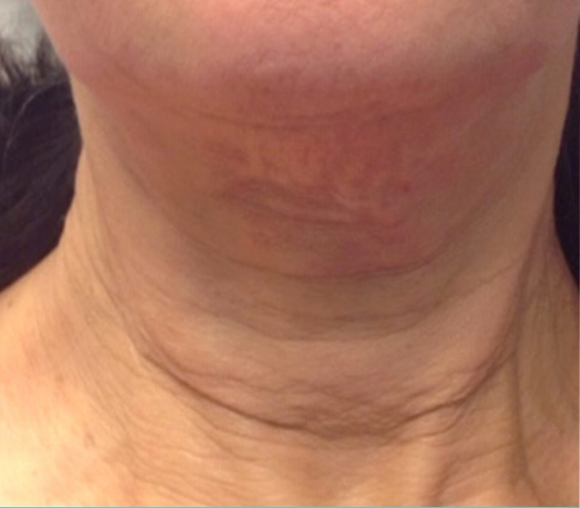 rakus-secret-beforeafter4