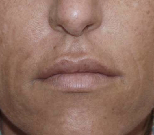 rakus-secret-beforeafter6