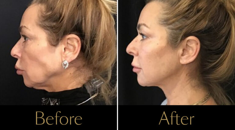 rakus-sofwave-gallery