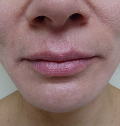 rakus-thermageflx-beforeafter