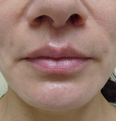 rakus-thermageflx-beforeafter2