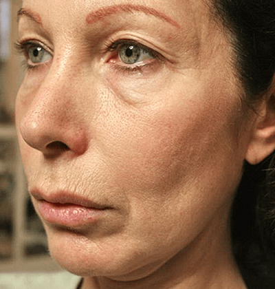 rakus-thermageflx-beforeafter3