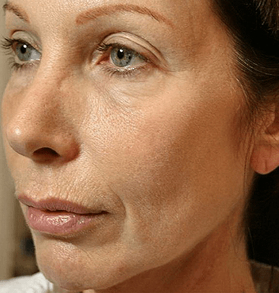 rakus-thermageflx-beforeafter4