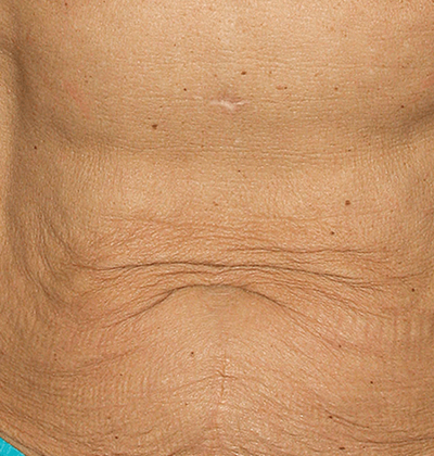 rakus-thermageflx-beforeafter5