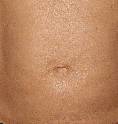 rakus-thermageflx-beforeafter6