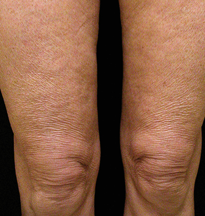 rakus-thermageflx-beforeafter7