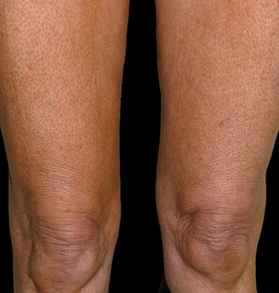 rakus-thermageflx-beforeafter8