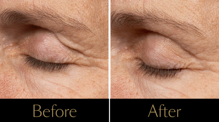 rakus-thermageflx-gallery