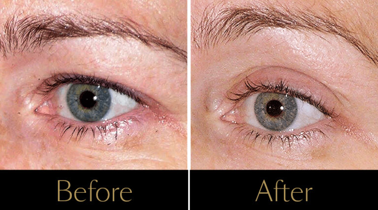 rakus-thermageflx-gallery2