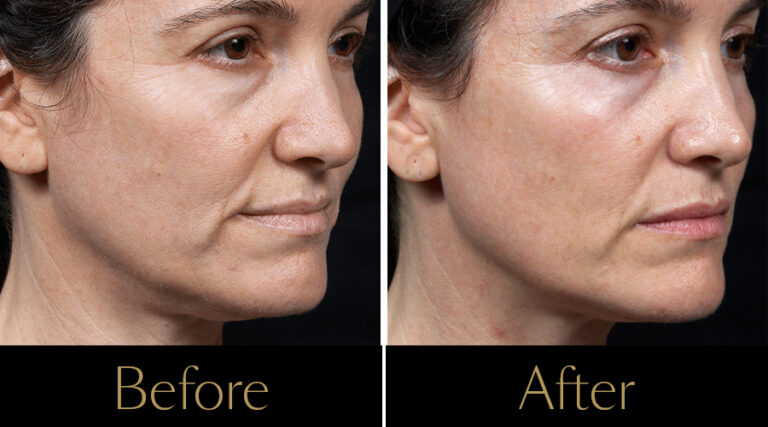 rakus-thermageflx-gallery3