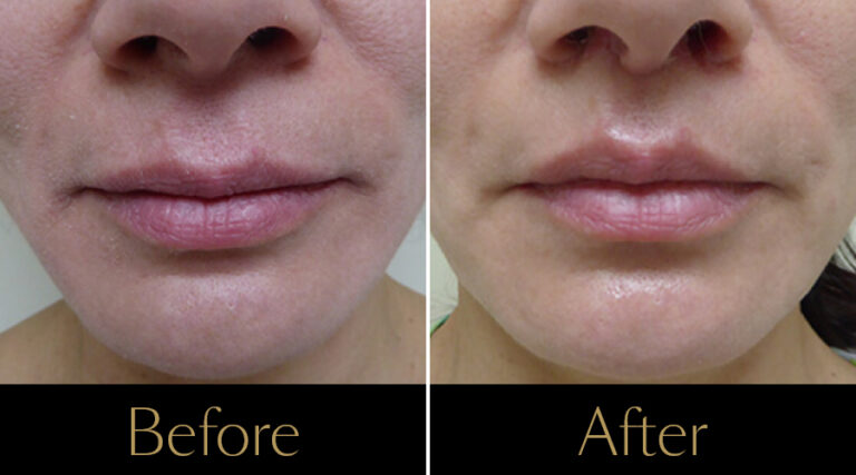 rakus-thermageflx-gallery4