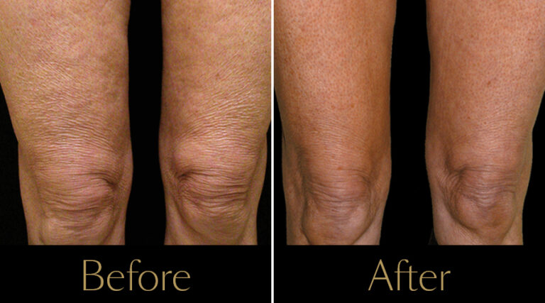 rakus-thermageflx-gallery5