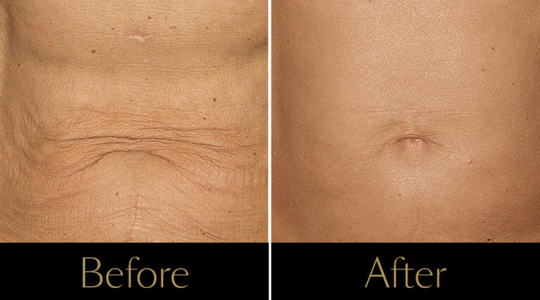 rakus-thermageflx-gallery6