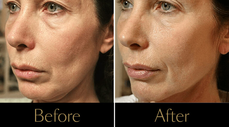 rakus-thermageflx-gallery7