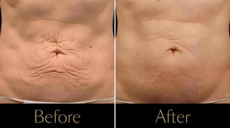 rakus-thermageflx-gallery8