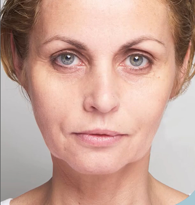 rakus-threadlift-beforeafter