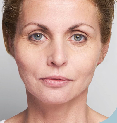 rakus-threadlift-beforeafter2