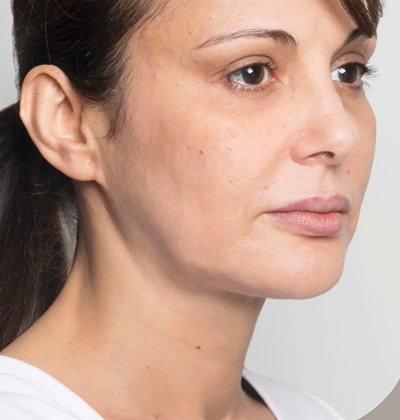 rakus-threadlift-beforeafter3