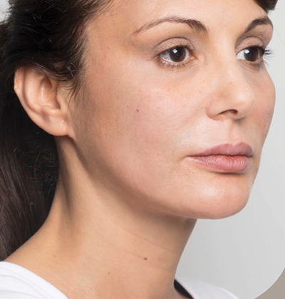 rakus-threadlift-beforeafter4