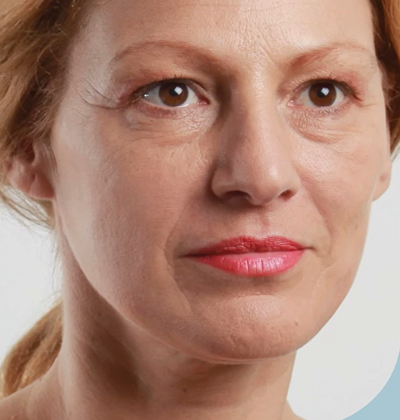 rakus-threadlift-beforeafter8