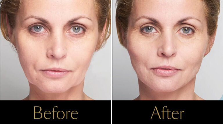 rakus-threadlift-gallery