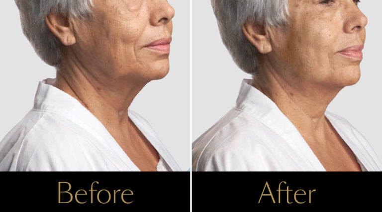 rakus-threadlift-gallery2