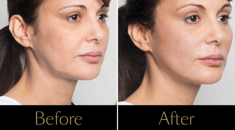 rakus-threadlift-gallery3