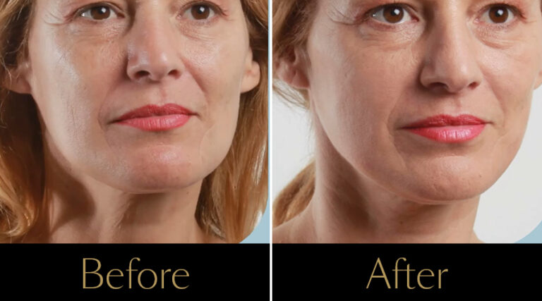 rakus-threadlift-gallery4