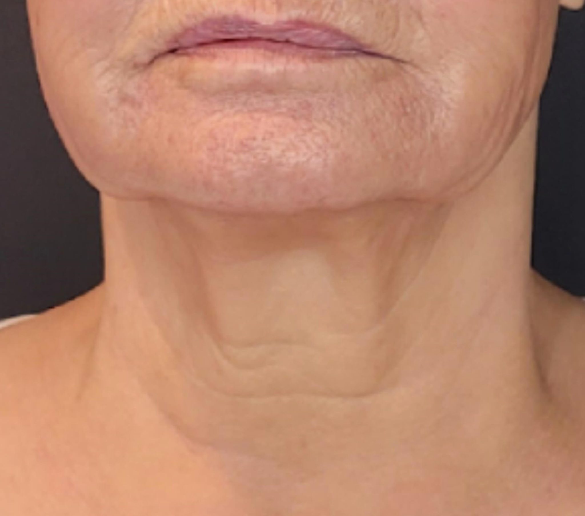 sofwave-Neck-Smile-and-Skin-After-3-months-page-279-1-2048x1808